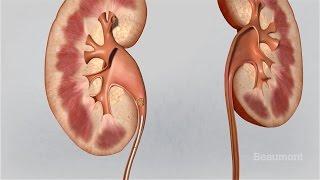 Kidney Stones Symptoms and Treatments