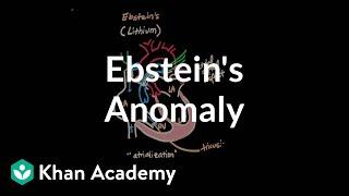 Ebsteins anomaly  Circulatory System and Disease  NCLEX-RN  Khan Academy