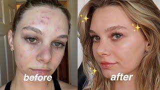 Everyday Natural Makeup Routine with Acne  how i cover my acne