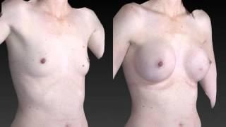 Breast Enhancement 3D Before and After-59