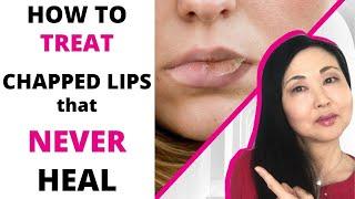 How to TREAT Chapped Lips that never heal  Actinic Cheilitis-4 GRADES