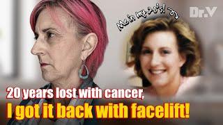 Part 1 20 years lost with cancer and rediscovering my youth through facelift