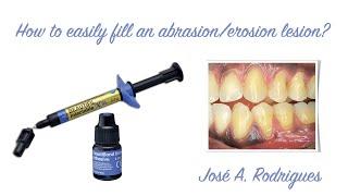 How to easily fill abrasion erosion lesion