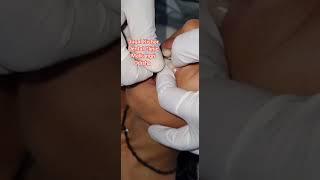 Dental Implant placement in Upper anterior tooth region