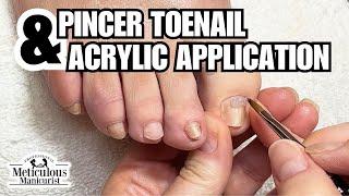 Fix for Yellow Toenails at Home #nails #satisfying