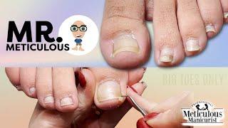 Impacted Toenail PEDICURE Cleaning on Mr. Meticulous Big Toes