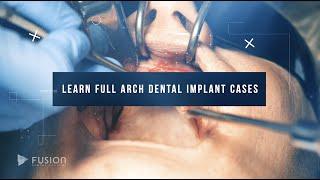 Learn Full Arch Dental Implant Cases