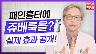 패인흉터 치료에  쥬베룩 해봤더니 피부과전문의 실제 시술 후기‍️여드름 흉터