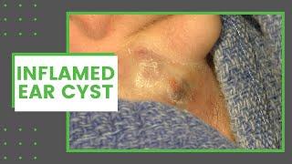 Inflamed Ear Cyst  Dr. Derm