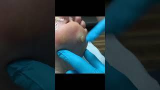 Doctor caught in the splash zone #warts #pops #foot #healthyfeet #podiatry #podiatrist #feetcare