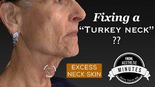 72 yo Turkey Neck Lift - Re-Tightening the Neck  Aesthetic Minutes #Necklift