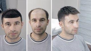 PROTEZ SAÇ - Hair Replacement