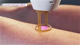 Laser hair removal - GentleMax Pro Plus 3D medical device animation