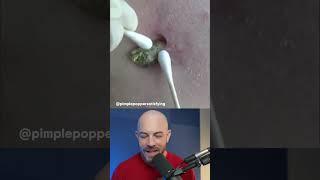 GIANT blackhead removal #dermreacts #blackheadextraction