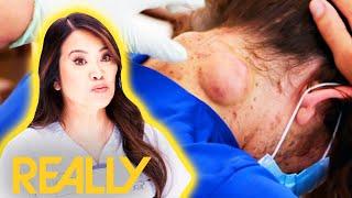 Man Seeks Dr Lees Aid For Painful Neck Cysts  Dr. Pimple Popper Pop Ups