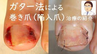 巻き爪治療の紹介【ガター法】による陥入爪治療　Ingrown Toenails conservative therapy by gutter splint　（手術・潰瘍・肉芽）