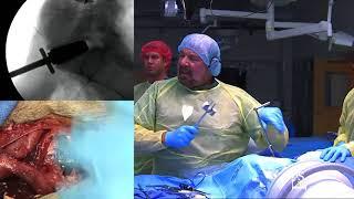 Anterior Lumbar Interbody Fusion -Jack E. Zigler M.D. FACS & Emre Yilmaz M.D.