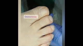 Онихолизис. Отслоение ногтя от ногтевого ложа.
