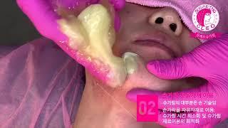 1-2mm 짧은 수염제모 슈가링  왁싱