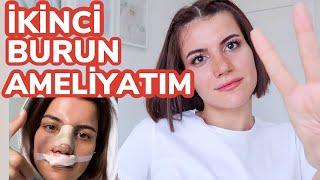 NEDEN 2. KEZ BURUN AMELİYATI OLDUM?  Revizyon Rinoplasti