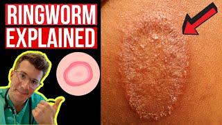 Doctor explains Ringworm aka Tinea including symptoms signs causes and treatment