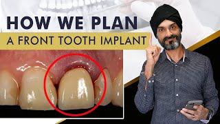 How We Plan Front Tooth Dental Implants