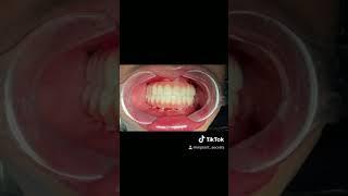 Full arch dental implants