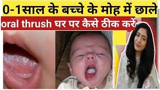 0-1 साल के छोटे बच्चे के मुंह मे छाले Oral Thrush कारण और कैसे सही करे। Bacho ke Muh me Chale.