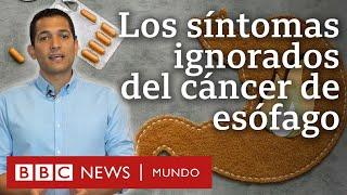 Cuáles son los síntomas del cáncer de esófago y por qué no debemos ignorarlos  BBC Mundo