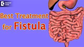 What is the best treatment for fistula? - Dr. Rajasekhar M R