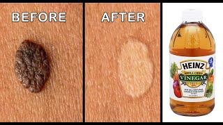 Mole Removal By Apple Cider Vinegar  Effective Ways to Remove Skin Tags Naturally