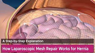 How Laparoscopic Mesh Repair Works for Hernia A Step-by-Step Explanation