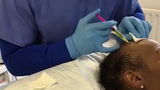 Hair Loss Treatment. Platelet Rich Plasma PRP procedure for Hair Restoration. Birmingham