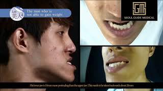 Life Altering Korean Plastic Surgery Transformation Show  Seoul Guide Medical