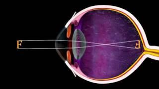 The Eye and Focus - 3D Medical Animation  ABP ©
