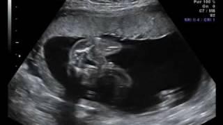 20 Week Ultrasound - Baby Boy