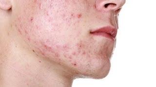 How to Control & Treat Severe Acne  Acne Treatment