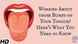 Worried About Those Bumps on Your Tongue? Heres What You Need To Know