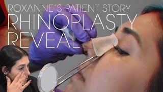 Rhinoplasty Reveal One Week After Surgery  Dr. Kian Karimi