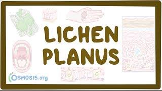 Lichen planus - causes symptoms diagnosis treatment pathology