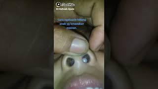 cara bersihin hidung anak yg kemasukan mainan