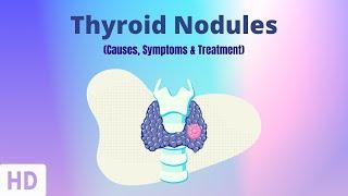 Thyroid Nodules Causes Symptoms and Treatment