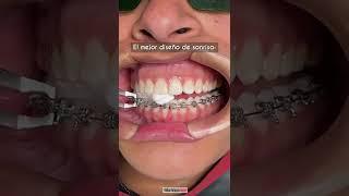 El mejor diseño de sonrisa  Adiós Brackets - Odontología Láser #Shorts