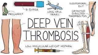 Understanding Deep Vein Thrombosis DVT