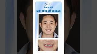 Biến răng ố vàng thành nụ cười rạng rỡ với Veneer Sứ  #feedback #Veneer #smileht #nhakhoasmileht