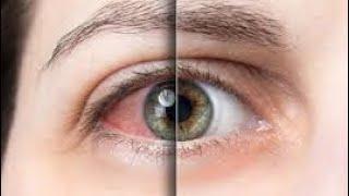 Сухость в глазах. Как увлажнить глаза без аптечных средств? Синдром сухого глаза песок и жжение.