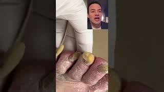 DOCTOR REACTS LOOK HOW LONG THESE TOENAILS ARE #shorts #reaction