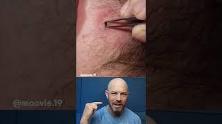 Cliffhanger Pimple Removal #pimplepop #dermreacts #doctorreacts