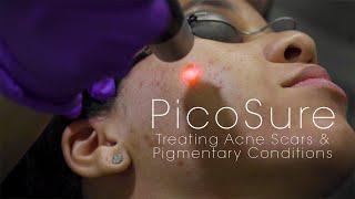 PicoSure Laser for Acne Scars & Pigmentation