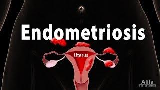 Endometriosis Pathology Symptoms Risk factors Diagnosis and Treatment Animation